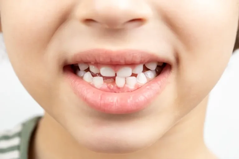 Todo lo que debes saber sobre los dientes de leche