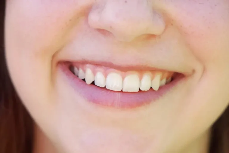 Blanqueamiento dental: ¿Por qué se manchan nuestras piezas dentales?