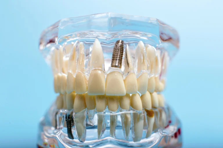 Implantes Dentales: ¿Qué son y cómo funcionan?