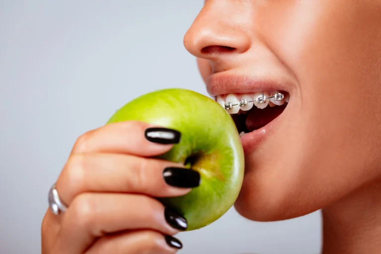 ¿Qué puedo comer con brackets? Consejos sobre la alimentación adecuada durante el tratamiento