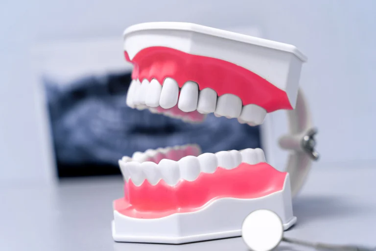 Gingivitis: Cómo detectarla y cuál es su tratamiento