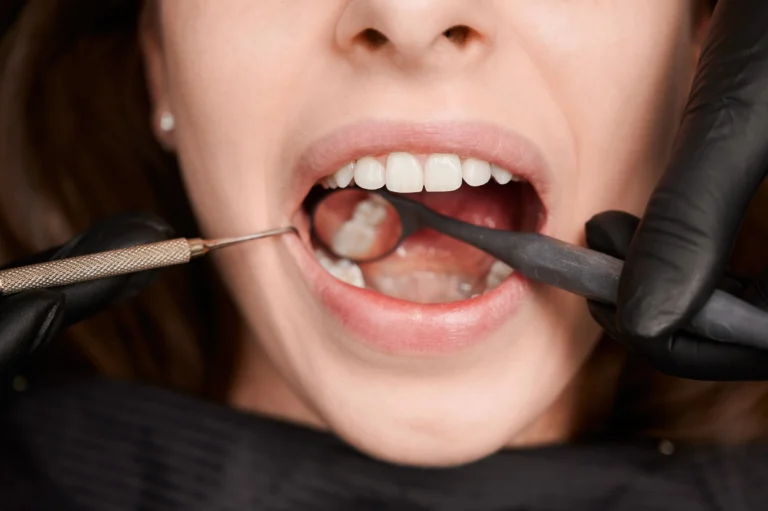 Caries dental: ¿Qué es y por qué se forma?