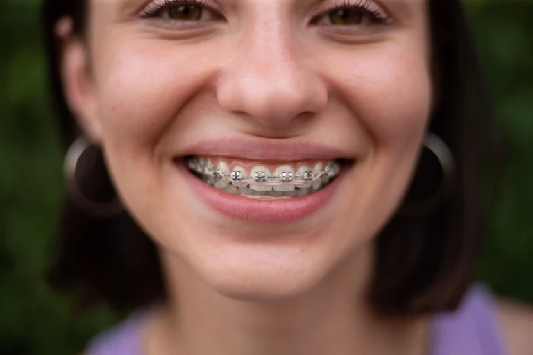 ¿Cómo colocar las gomas en la ortodoncia de brackets?