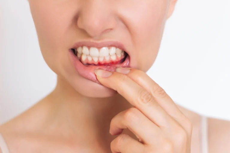 ¿Es Normal Que Sangren Las Encías Al Cepillarse?