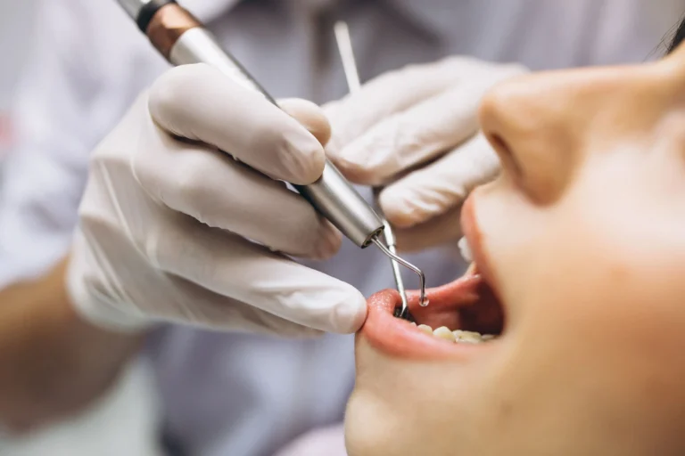 Empaste dental: qué es, cuándo se necesita y cómo ayuda a conservar el diente