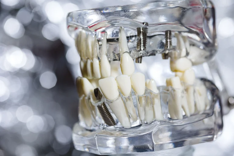 Factores que determinan el precio de un implante dental en Toledo