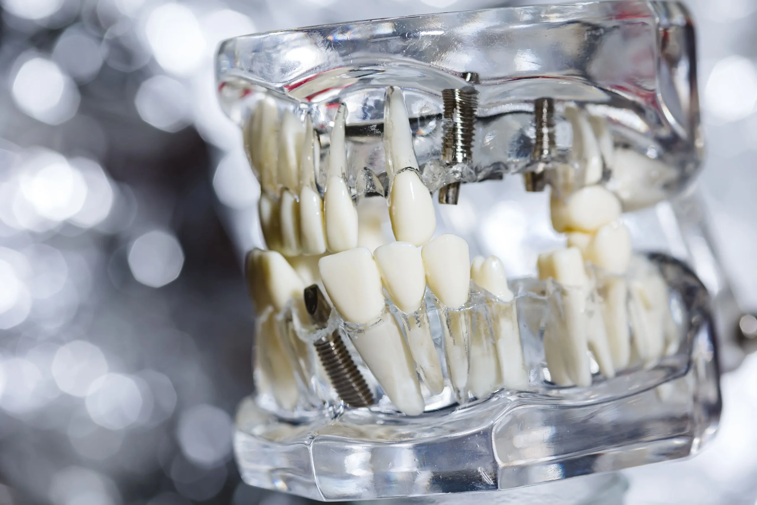 Factores que determinan el precio de un implante dental en Toledo