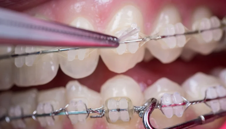 Brackets metálicos, estéticos o invisibles comparativa completa ortodoncia en toledo mingari